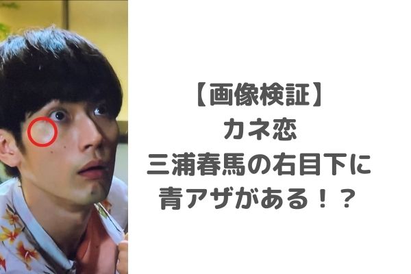 画像 カネ恋三浦春馬の右目下に青痣がある 顔以外にも痣があったのではないかという疑惑も みーよんらいふ